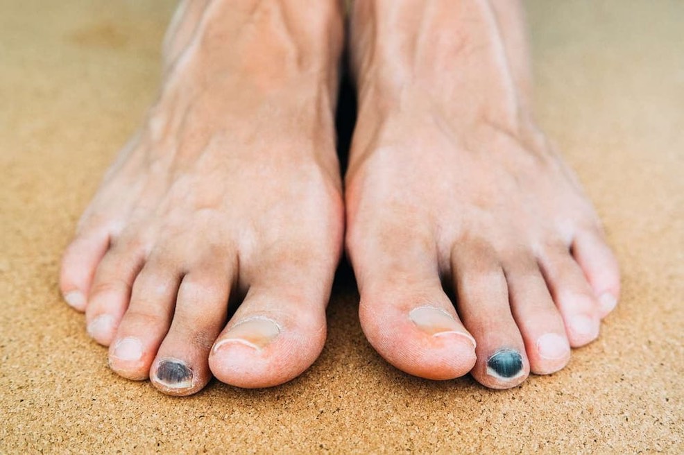 Why-Do-Runners-Get-Black-Toenails-1
